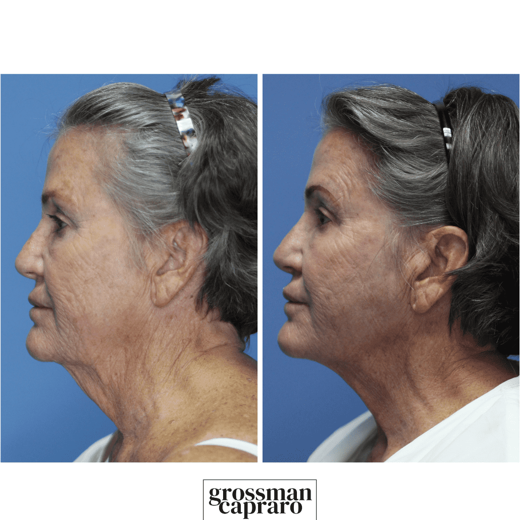 Facial Liposuction And Renuvion Grossman Capraro Plastic Surgery