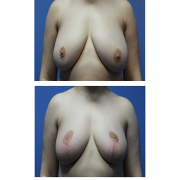 Breast Reduction | Denver | Beverly Hills, CA - Grossman Capraro