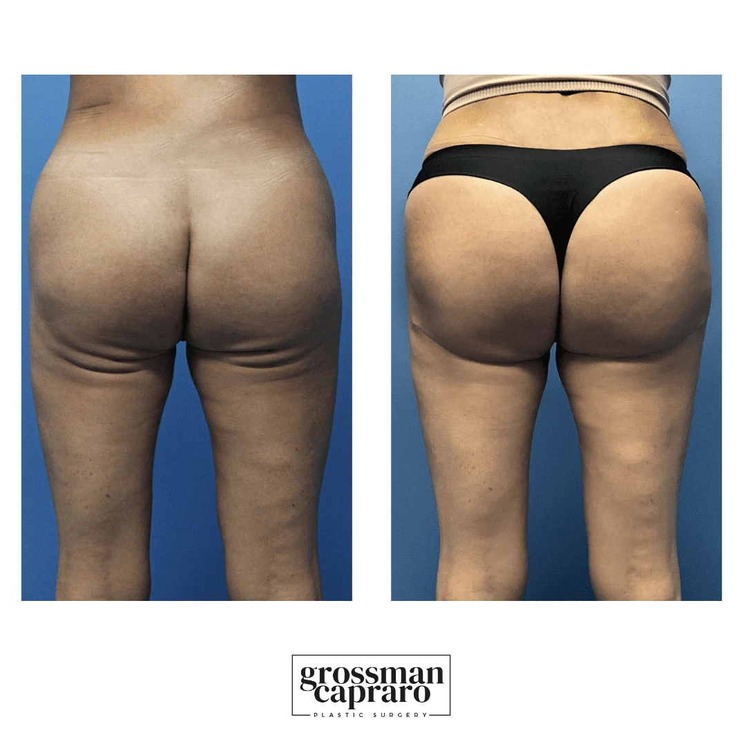 Achieve Desired Buttocks Appearance With Butt Augmentation