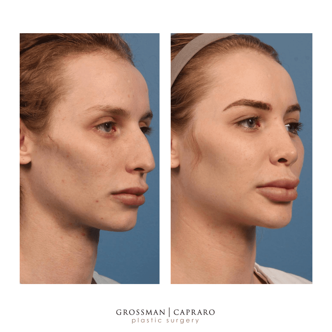 Facial Liposuction | Denver | Beverly Hills, CA - It can be used to address isolated fatty deposits in the cheeks, jaw line neck & double chin.