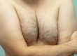 Gynecomastia cause