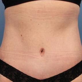Abdominoplasty
