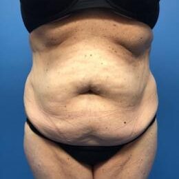 Abdominoplasty