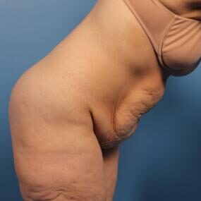 Abdominoplasty