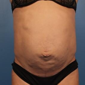 Abdominoplasty