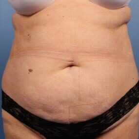 Abdominoplasty