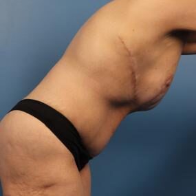 Abdominoplasty