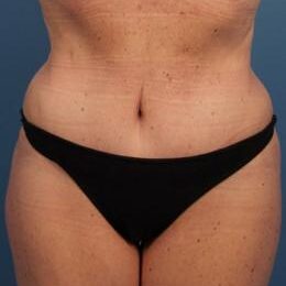Abdominoplasty