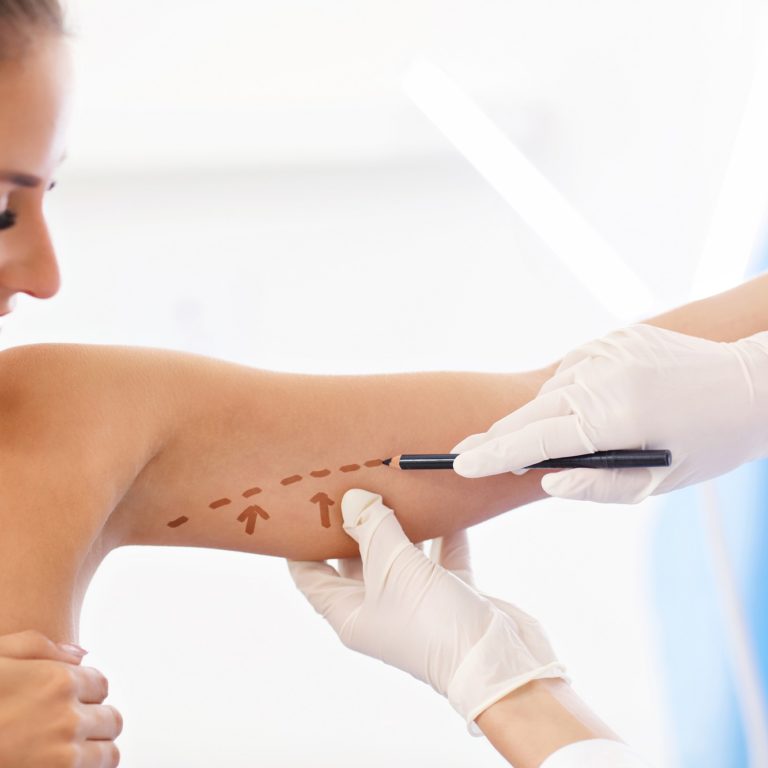 Brachioplasty (Arm Lift) in Denver, Greenwood Village, CO & Beverly Hills, CA