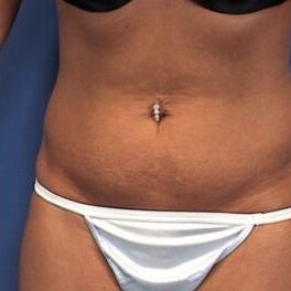 Abdominoplasty