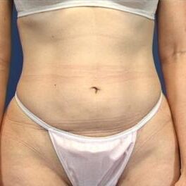Abdominoplasty