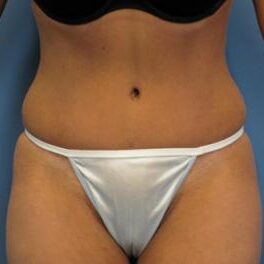 Abdominoplasty