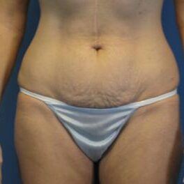 Abdominoplasty