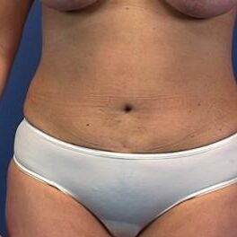 Abdominoplasty
