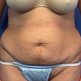 Abdominoplasty