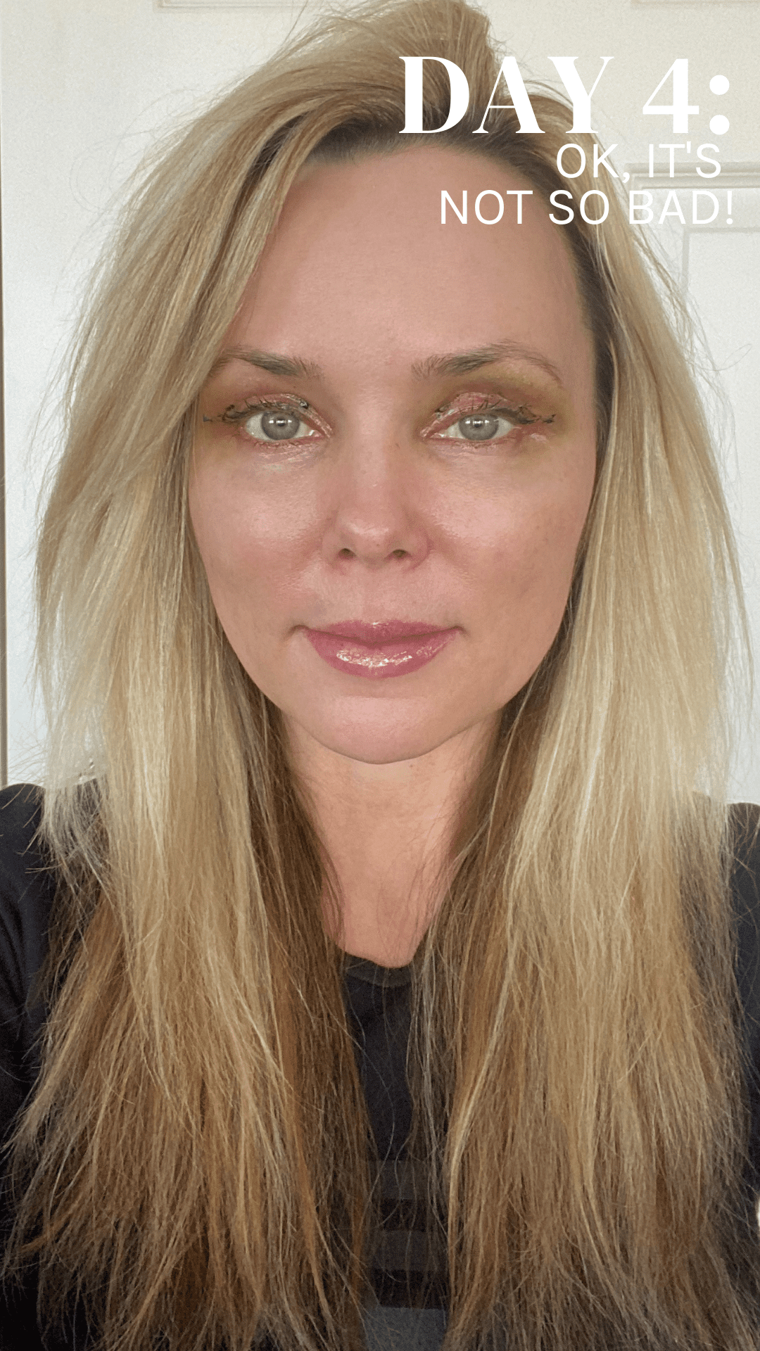 Patient Diary – What's it like to have an upper eyelids blepharoplasty? Day 4