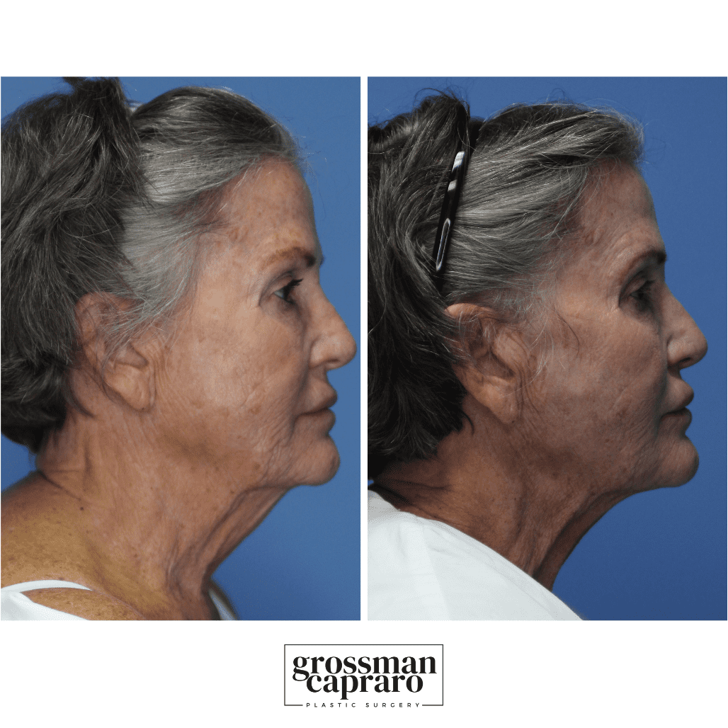 Renuvion® | Denver | Beverly Hills, CA - Grossman Capraro