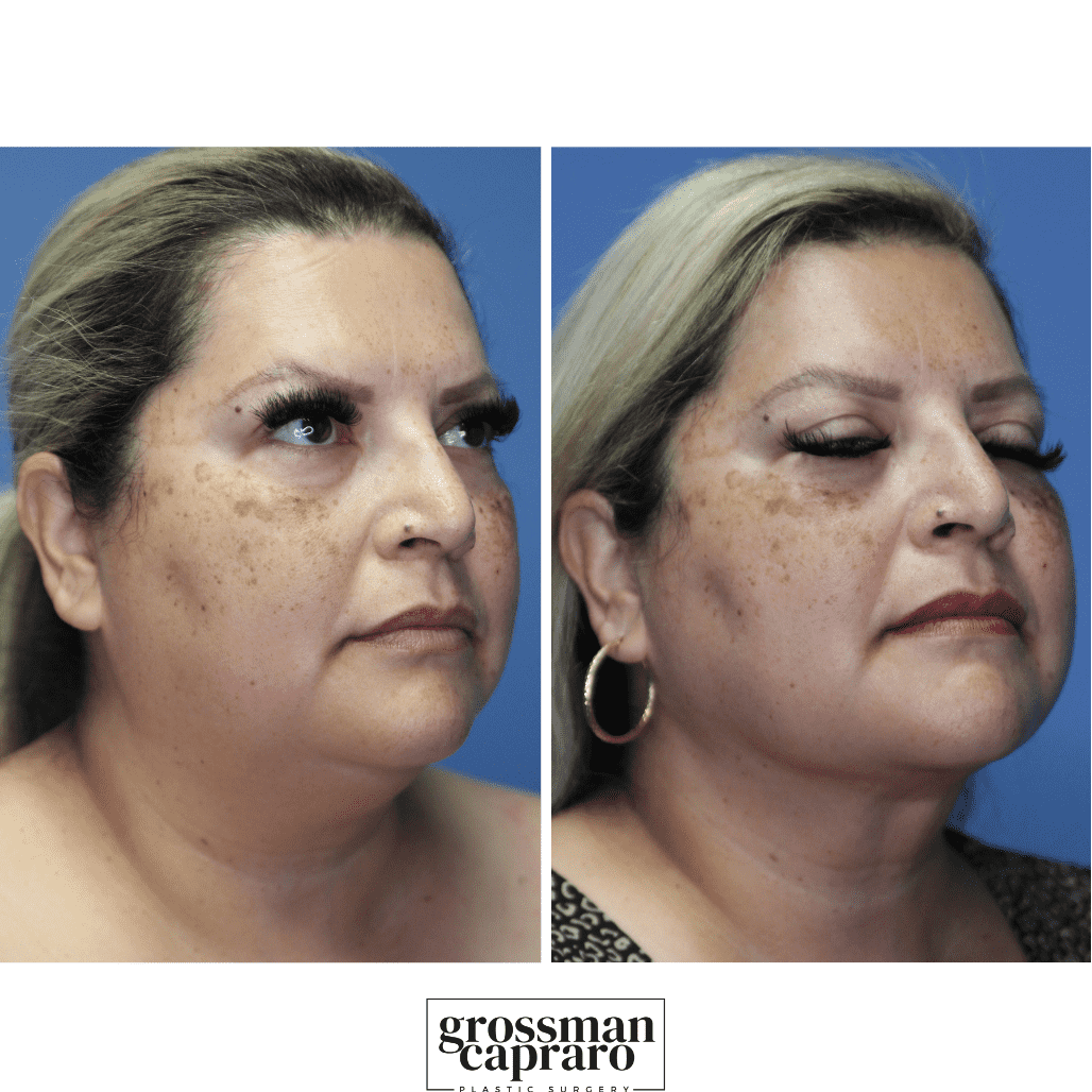 Renuvion® | Denver | Beverly Hills, CA - Grossman Capraro