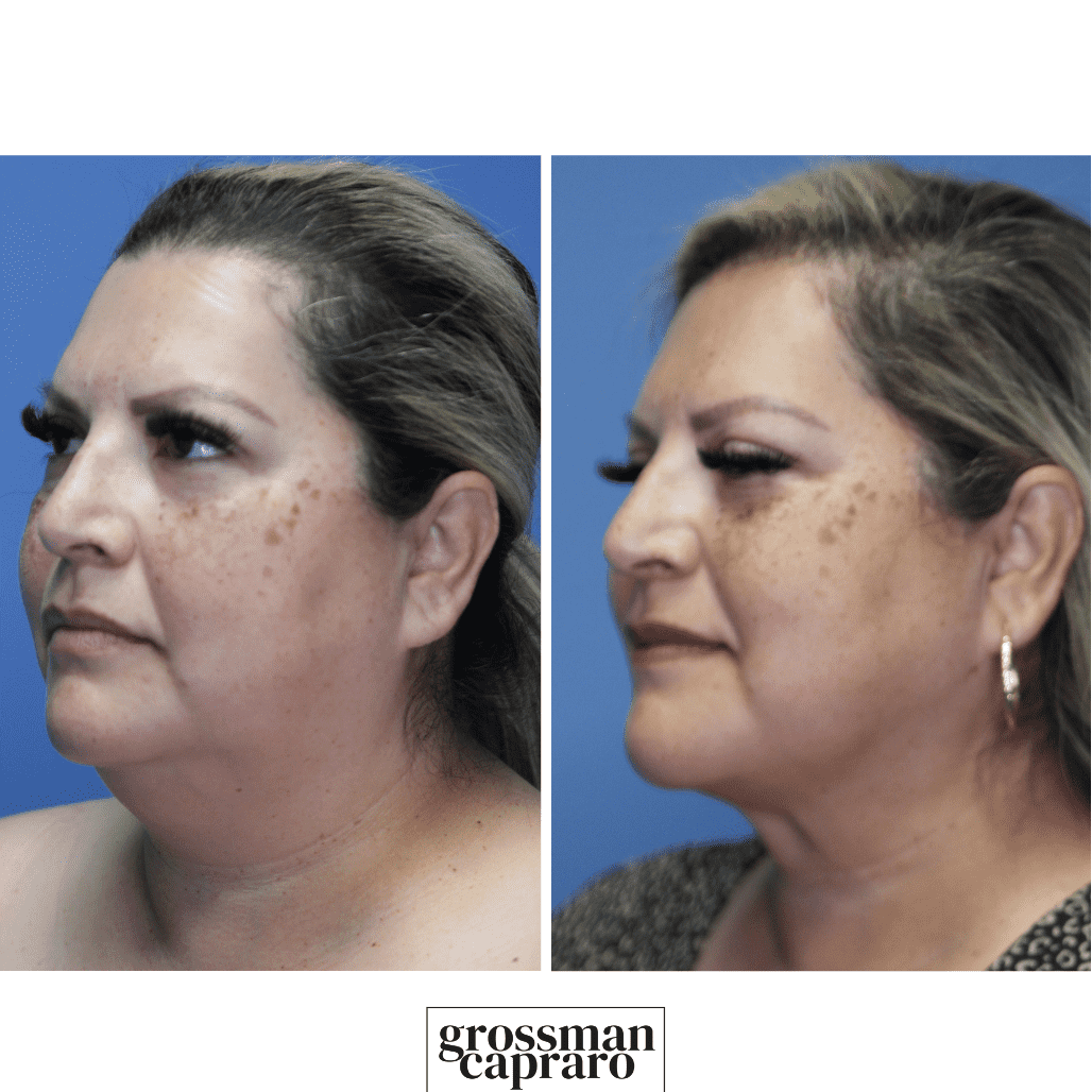 Renuvion® | Denver | Beverly Hills, CA - Grossman Capraro