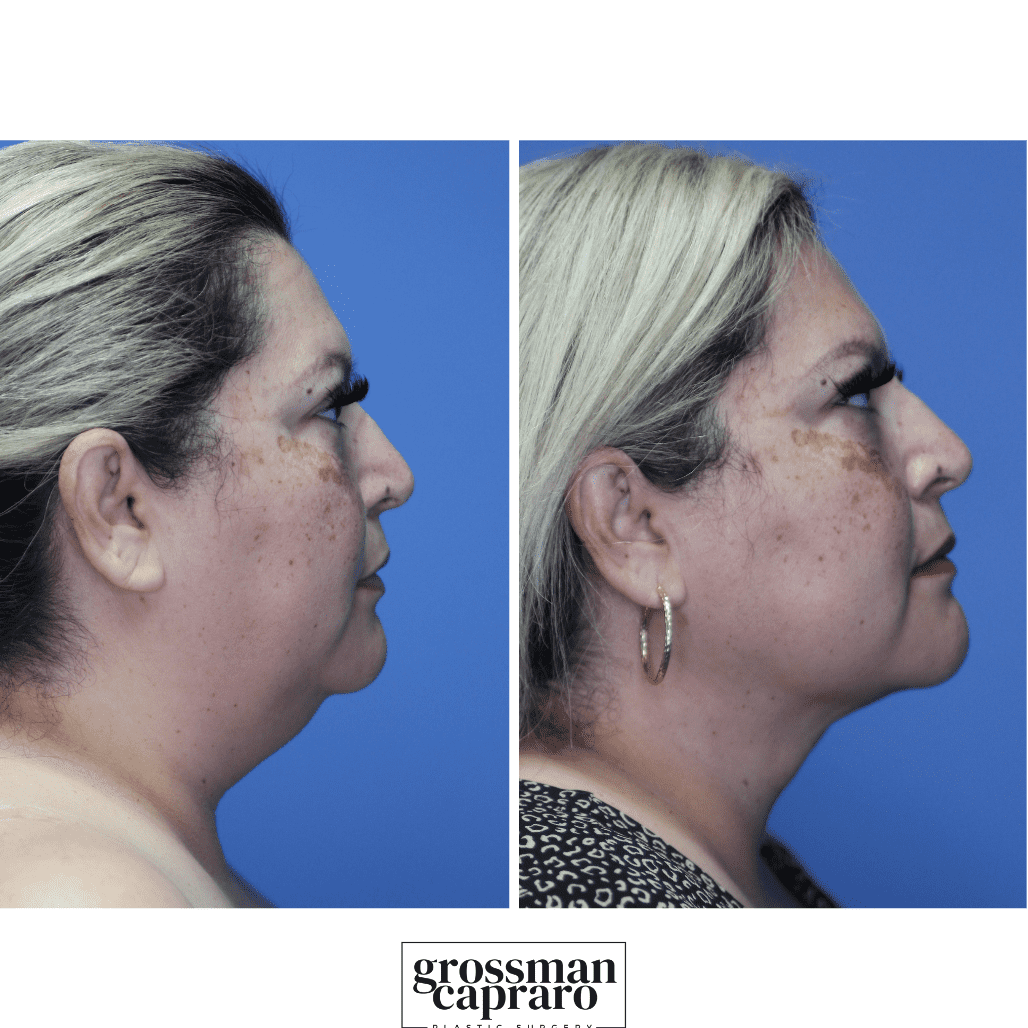 Renuvion® | Denver | Beverly Hills, CA - Grossman Capraro