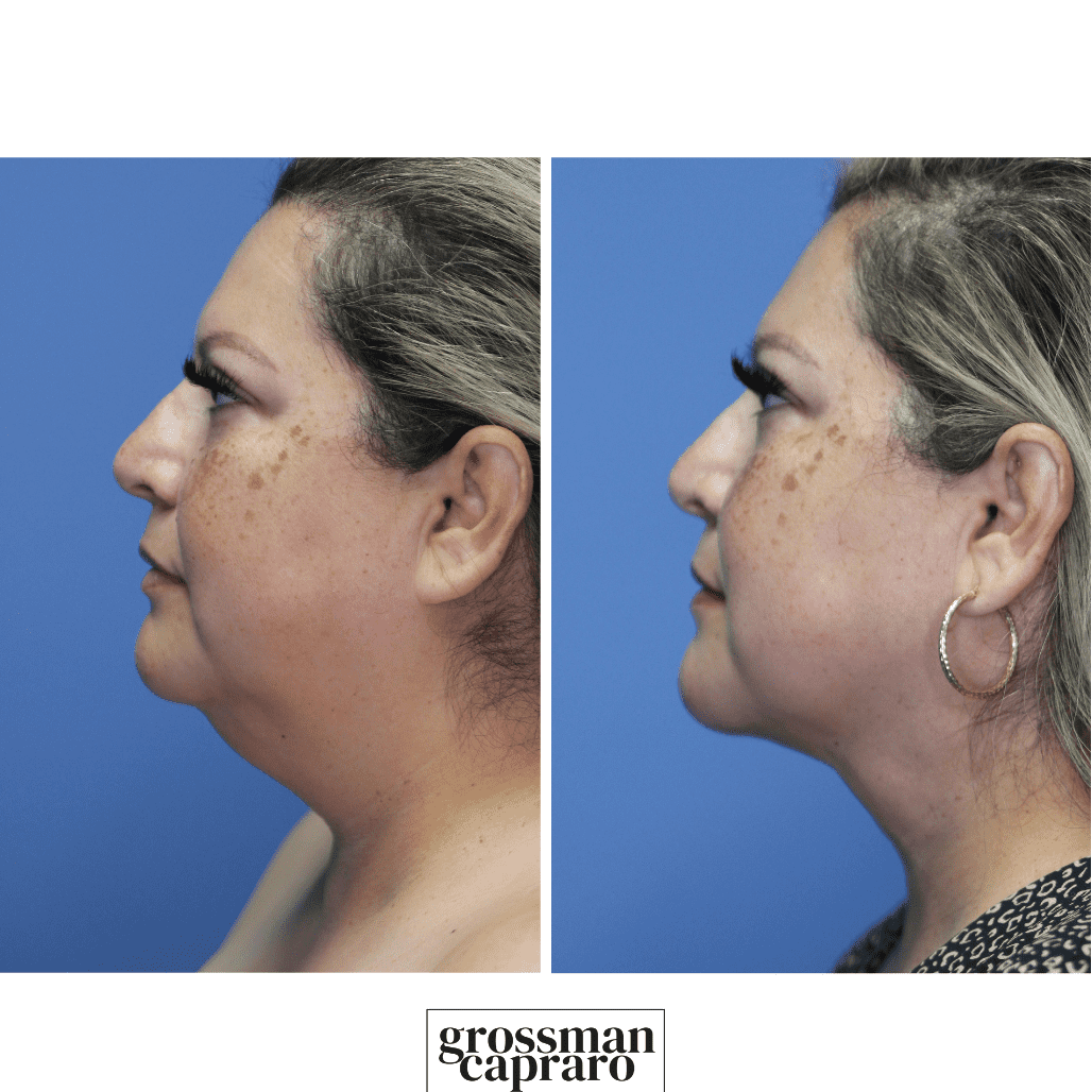 Renuvion® | Denver | Beverly Hills, CA - Grossman Capraro