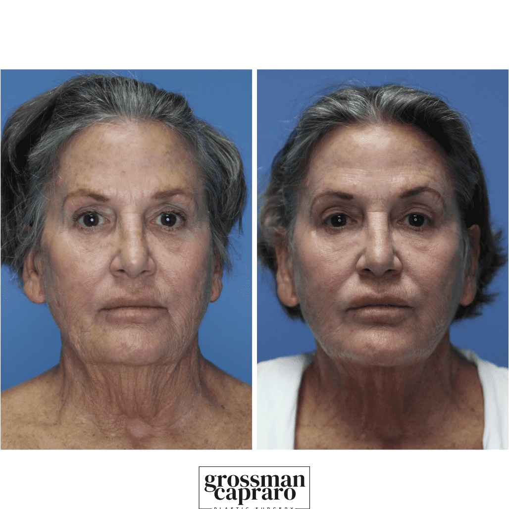 Renuvion® | Denver | Beverly Hills, CA - Grossman Capraro