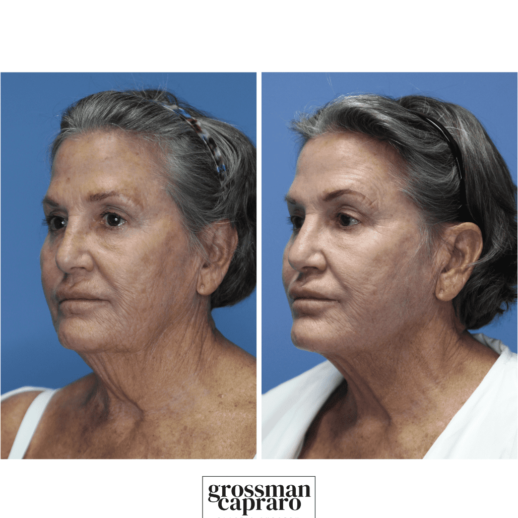 Renuvion® | Denver | Beverly Hills, CA - Grossman Capraro