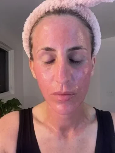 CO2 Tetra DOT Laser Procedure