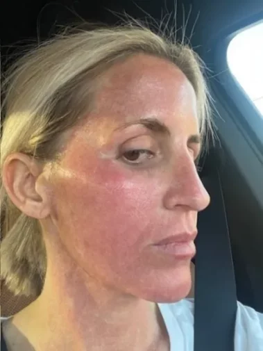 CO2 Tetra DOT Laser Procedure After Image